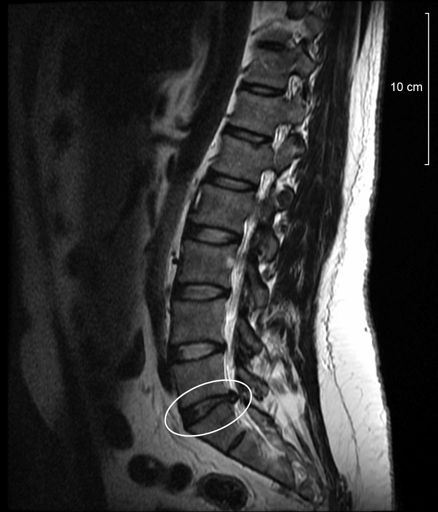Photo of spinal disc protrusion l5