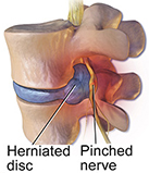 illustrated example of a pinched back nerve